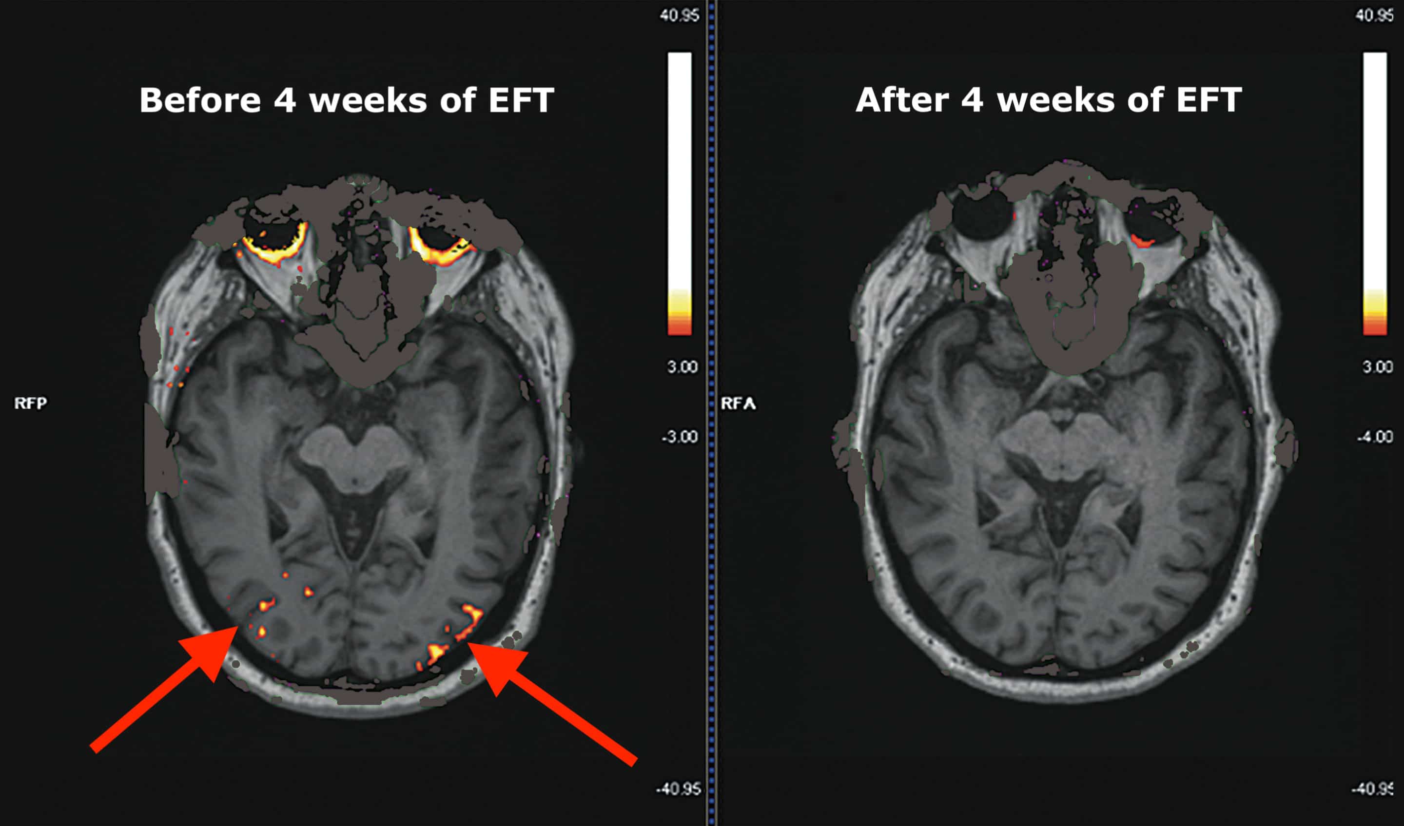 Brain scan images showing the effects of EFT Tapping before and after. 